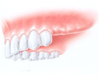 implantologia denti multipli  - avellino studio dentistico dargenio