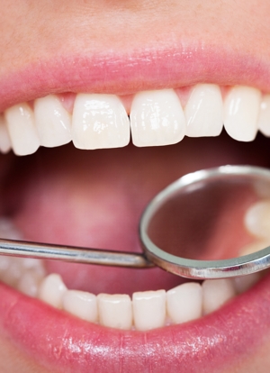 Carie e parodontite i principali disturbi del cavo orale per l'oms.