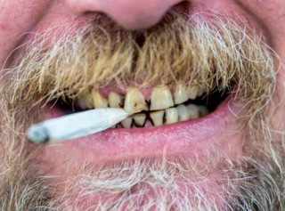 Fumo e danno parodontale:  tabacco fa perdere  gli elementi dentari