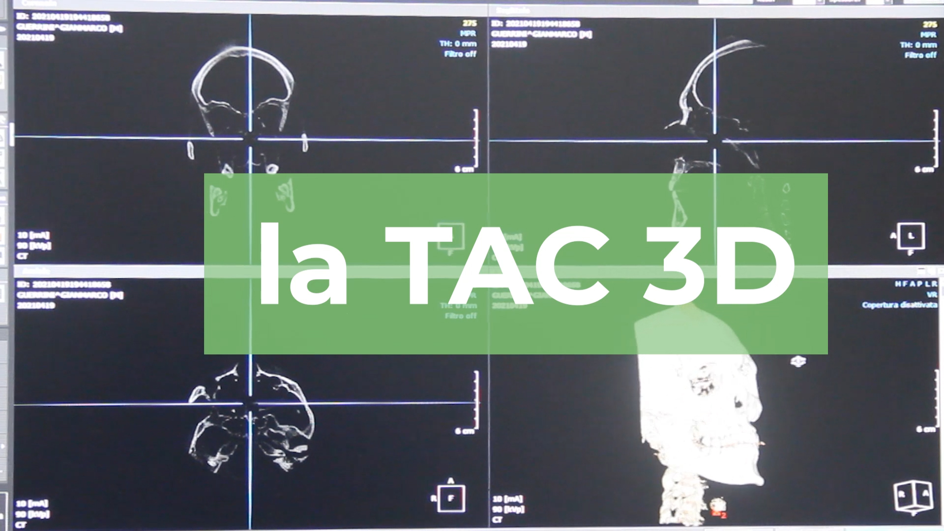 La TAC 3D a bassissima emissione di raggi x